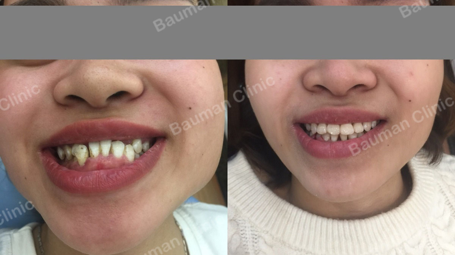Ca niềng răng số 5066 - Nha khoa Bauman Clinic