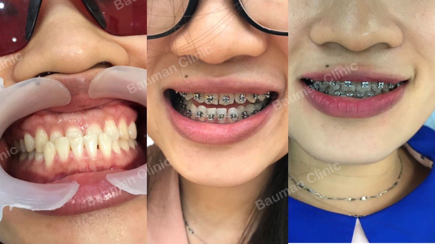 Ca niềng răng số 5083 - Nha khoa Bauman Clinic