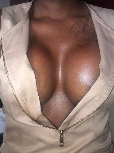 Trải nghiệm làm ngực với túi gel silicon Inspira HP/X 700/750cc ở bà mẹ 2 con cao 1m65, nặng 70kg