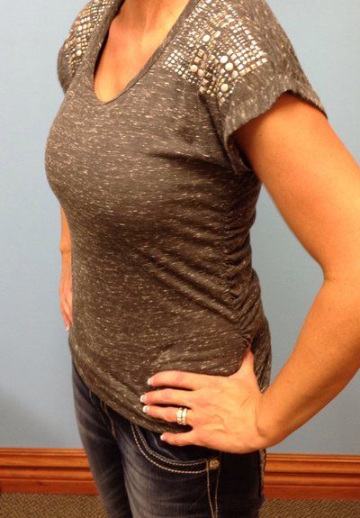 Mẹ 2 con, 36 tuổi nâng ngực bằng túi gel silicon Natrelle Style 15, dung tích 575cc dáng tròn, vỏ trơn, độ nhô trung bình cộng, đặt dưới cơ, đường mổ chân ngực