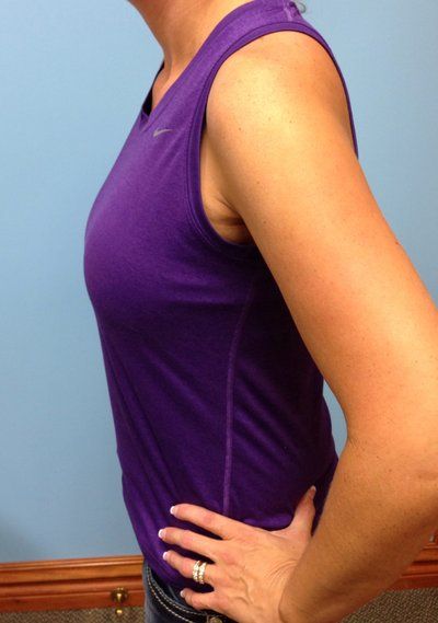 Mẹ 2 con, 36 tuổi nâng ngực bằng túi gel silicon Natrelle Style 15, dung tích 575cc dáng tròn, vỏ trơn, độ nhô trung bình cộng, đặt dưới cơ, đường mổ chân ngực