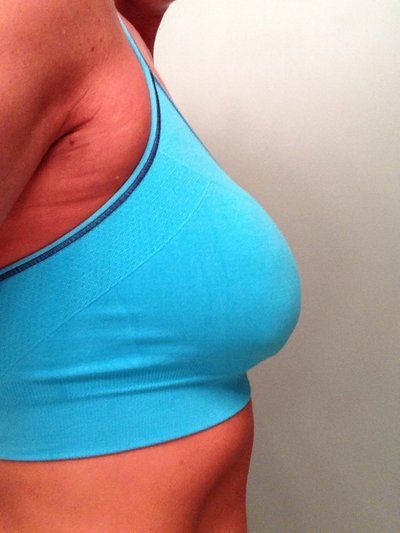 Mẹ 2 con, 36 tuổi nâng ngực bằng túi gel silicon Natrelle Style 15, dung tích 575cc dáng tròn, vỏ trơn, độ nhô trung bình cộng, đặt dưới cơ, đường mổ chân ngực