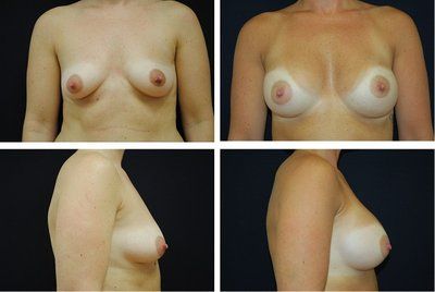 Mẹ 2 con, 36 tuổi nâng ngực bằng túi gel silicon Natrelle Style 15, dung tích 575cc dáng tròn, vỏ trơn, độ nhô trung bình cộng, đặt dưới cơ, đường mổ chân ngực