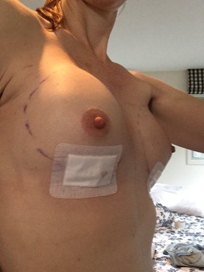 Nâng ngực bằng túi độn gel silicon 275cc dáng tròn, vỏ trơn, độ nhô trung bình cộng ở phụ nữ 36 tuổi