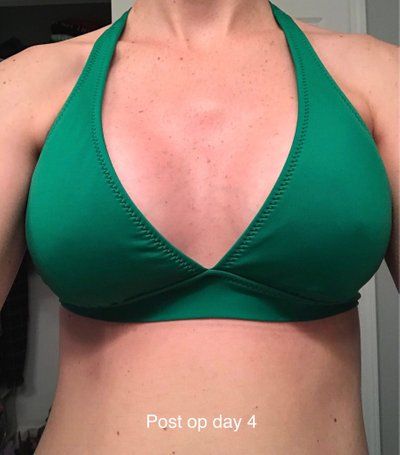 Nâng ngực với túi gel silicon natrelle, độ nhô trung bình ở bà mẹ 2 con cao 1m79, nặng 59 kg