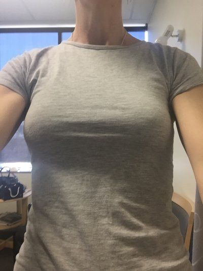 Nâng ngực bằng túi độn gel silicon 275cc dáng tròn, vỏ trơn, độ nhô trung bình cộng ở phụ nữ 36 tuổi