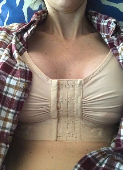 Nâng ngực với túi gel silicon natrelle, độ nhô trung bình ở bà mẹ 2 con cao 1m79, nặng 59 kg