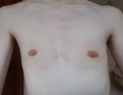 Hành trình nâng ngực của cô gái có ngực lép, phẳng, vẹo cột sống