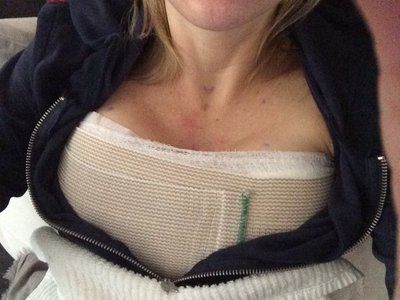 Nâng ngực bằng túi độn silicon 425cc, độ nhô cao trên khách hàng 36 tuổi đã có 2 con