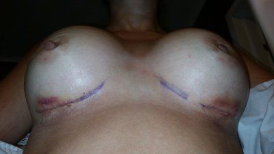 Hành trình nâng ngực của mẹ trẻ 4 con ở độ tuổi 27 tuổi (cao 1m62, ngực ban đầu cỡ 34AA, 4 con, đặt túi độn HP 425cc, dưới cơ)