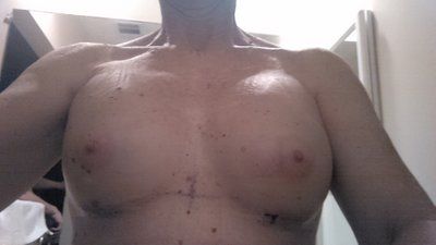 Mẹ đơn thân mắc ung thư da vẫn quyết tâm nâng ngực sau khi đã hoàn thành việc nuôi dạy 2 con