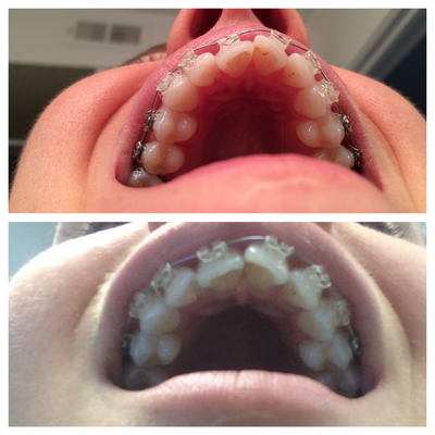 Niềng răng ở tuổi 28