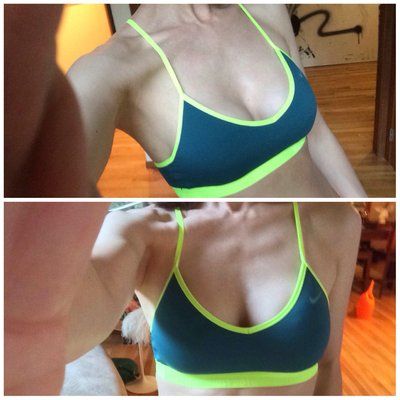 Quá trình nâng cấp vòng 1 của quý bà “team ngực lép” cao 1m72, nặng 56,6 kg