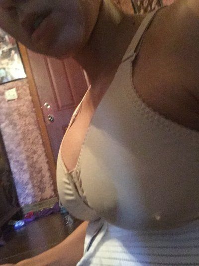 Nâng ngực bằng túi độn size 375cc trên khách hàng có thân hình nhỏ bé