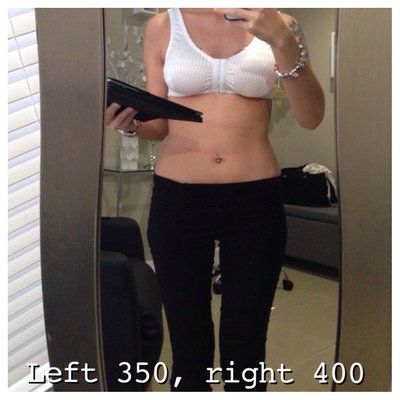 23 tuổi. Nâng ngực bằng túi độn size 400 cc. Đường mổ gần như vô hình ở dưới vú