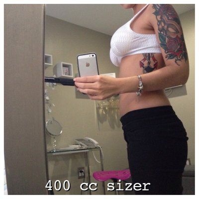 23 tuổi. Nâng ngực bằng túi độn size 400 cc. Đường mổ gần như vô hình ở dưới vú