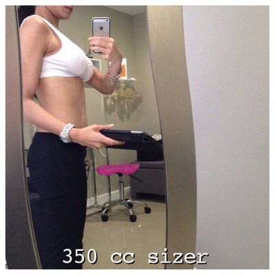 23 tuổi. Nâng ngực bằng túi độn size 400 cc. Đường mổ gần như vô hình ở dưới vú