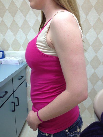 Hành trình nâng ngực của mẹ trẻ 2 con đặt túi độn nước muối 360cc độ nhô trung bình