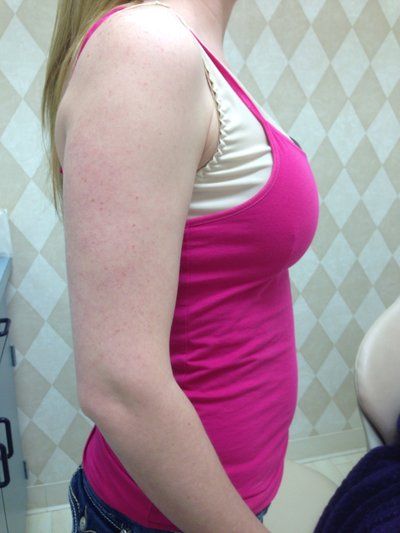 Hành trình nâng ngực của mẹ trẻ 2 con đặt túi độn nước muối 360cc độ nhô trung bình