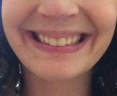 Hành trình niềng răng ở tuổi 22