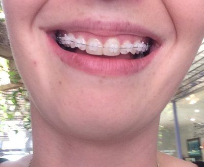 Hành trình niềng răng ở tuổi 22