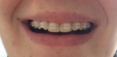 Hành trình niềng răng ở tuổi 22