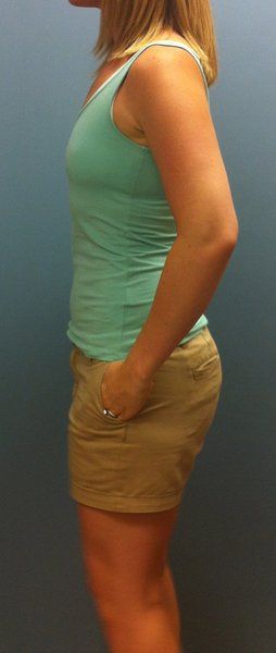 Mẹ trẻ 28 tuổi biến hóa ngực AA cup lên G cup với túi gel silicon 533cc