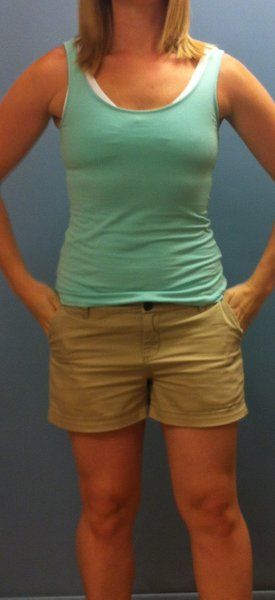 Mẹ trẻ 28 tuổi biến hóa ngực AA cup lên G cup với túi gel silicon 533cc