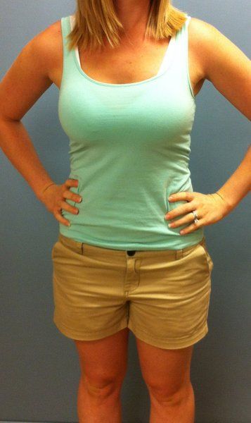 Mẹ trẻ 28 tuổi biến hóa ngực AA cup lên G cup với túi gel silicon 533cc