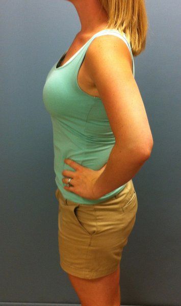 Mẹ trẻ 28 tuổi biến hóa ngực AA cup lên G cup với túi gel silicon 533cc