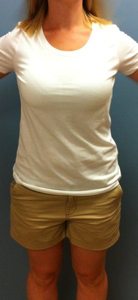 Mẹ trẻ 28 tuổi biến hóa ngực AA cup lên G cup với túi gel silicon 533cc