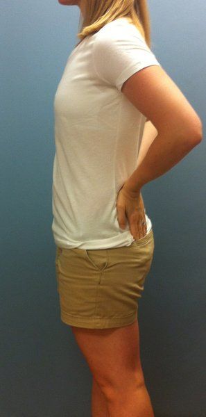 Mẹ trẻ 28 tuổi biến hóa ngực AA cup lên G cup với túi gel silicon 533cc