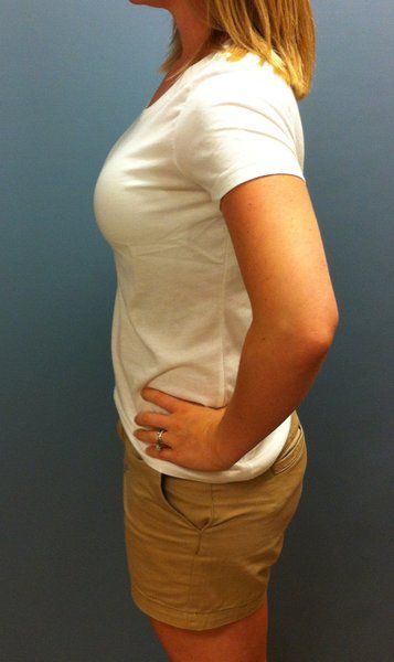 Mẹ trẻ 28 tuổi biến hóa ngực AA cup lên G cup với túi gel silicon 533cc