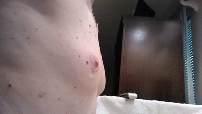 Mẹ đơn thân mắc ung thư da vẫn quyết tâm nâng ngực sau khi đã hoàn thành việc nuôi dạy 2 con