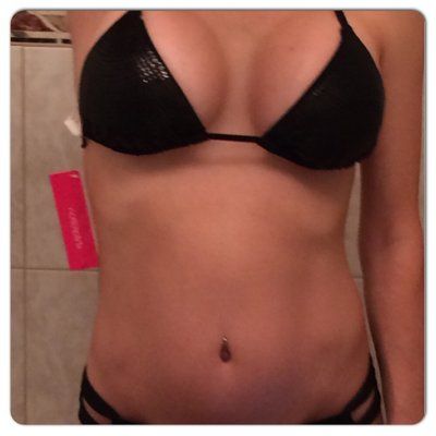 Nâng ngực bằng túi độn silicon 425cc, độ nhô cao trên khách hàng 36 tuổi đã có 2 con