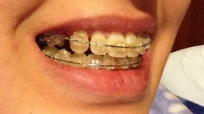 27 tuổi- niềng răng mắc cài trong suốt để khắc phục hô vẩu