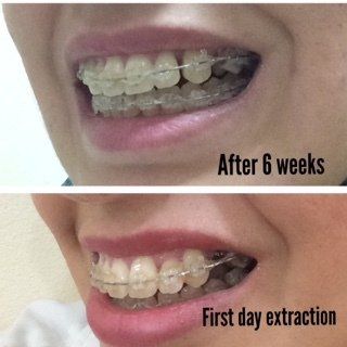 27 tuổi- niềng răng mắc cài trong suốt để khắc phục hô vẩu