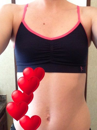 Hành trình nâng ngực của mẹ trẻ 2 con đặt túi độn nước muối 360cc độ nhô trung bình