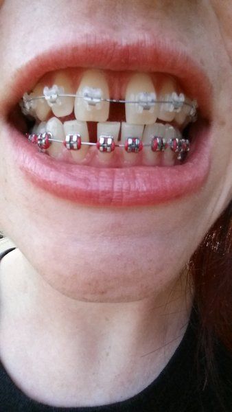 Niềng răng để khắc phục răng thưa