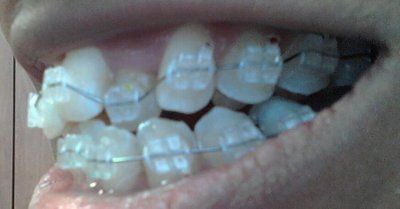 Trải nghiệm về quá trình niềng răng