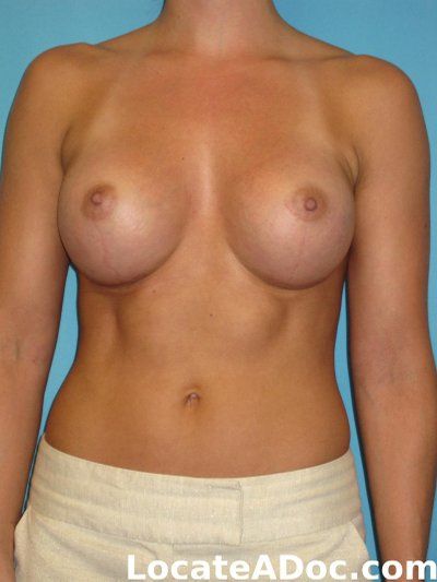 Mẹ đơn thân mắc ung thư da vẫn quyết tâm nâng ngực sau khi đã hoàn thành việc nuôi dạy 2 con