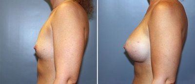 Mẹ trẻ 28 tuổi biến hóa ngực AA cup lên G cup với túi gel silicon 533cc