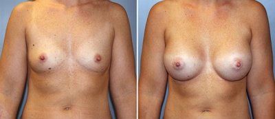 Mẹ trẻ 28 tuổi biến hóa ngực AA cup lên G cup với túi gel silicon 533cc