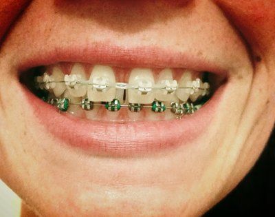 Niềng răng để khắc phục răng thưa