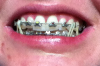 Niềng răng kim loại hiệu quả nhanh hơn và tốt hơn