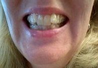 Nhật ký niềng răng trong suốt invisalign