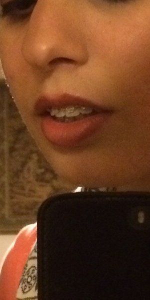 27 tuổi- niềng răng mắc cài trong suốt để khắc phục hô vẩu