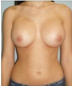 23 tuổi. Nâng ngực bằng túi độn size 400 cc. Đường mổ gần như vô hình ở dưới vú