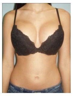 23 tuổi. Nâng ngực bằng túi độn size 400 cc. Đường mổ gần như vô hình ở dưới vú