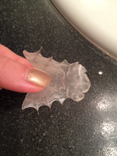 Niềng răng ở tuổi 28